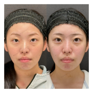 福岡天神で目の下のクマ取り｜20代女性の症例写真