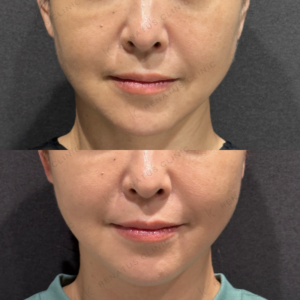 糸リフト症例写真の症例写真