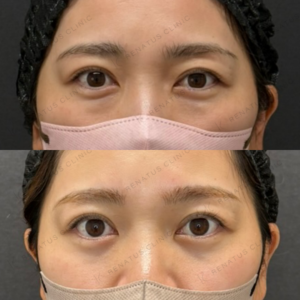 福岡天神で目の下のクマ取り｜30代女性がレナトゥスクリニックで実感した効果と料金の症例写真