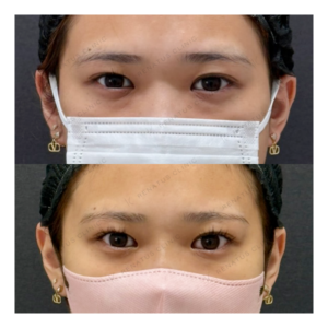 福岡天神で目の下のクマ取り｜20代女性が経結膜脱脂術で効果実感の症例写真