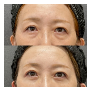 福岡天神の目の下のクマ取り料金・効果｜40代女性の事例の症例写真