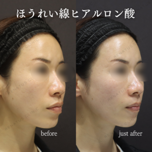 新宿でほうれい線ヒアルロン酸が上手いクリニック｜ダイヤモンドフィール使用・40代女性の効果と料金の症例写真