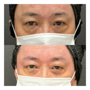福岡天神で目の下のクマ取り｜40代男性の効果と料金相場の症例写真