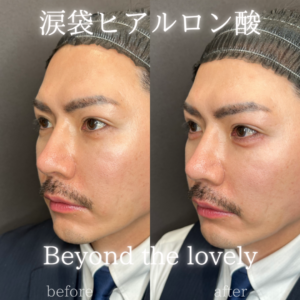 大阪梅田で涙袋ヒアルロン酸｜30代男性がボルベラで自然な涙袋を形成した効果と料金相場の症例写真