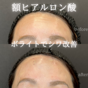 大阪梅田のヒアルロン酸（ボライト）額への効果と料金｜50代女性の症例の症例写真
