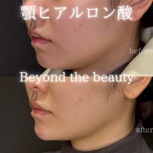 名古屋で顎ヒアルロン酸におすすめのボラックス｜20代女性の効果と料金の症例写真