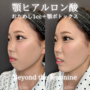 大阪梅田で顎ヒアルロン酸（ダイヤモンドフィール/ピネハ）の効果と料金｜10代女性の症例の症例写真