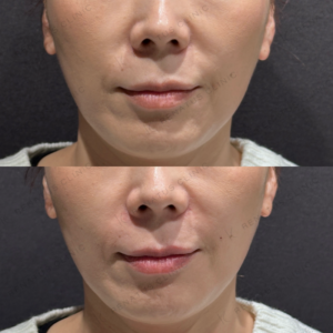 東京田町で鼻翼基部ヒアルロン酸｜ボリフトで自然な小鼻を叶えた40代女性の効果と料金の症例写真