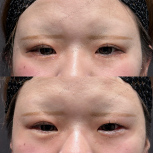 東京田町で涙袋ヒアルロン酸｜20代女性がボルベラで叶えた自然なうるみ目の効果と料金の症例写真