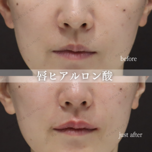 新宿で唇ヒアルロン酸ならボルベラ（VOLBELLA）｜30代女性の自然なふっくら唇の効果と料金相場の症例写真