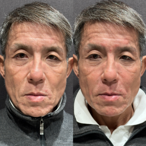 東京田町でほうれい線ヒアルロン酸が上手い名医｜ダイヤモンドフィール使用・50代男性の効果と料金の症例写真