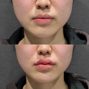 東京田町で唇・顎ヒアルロン酸｜ボルベラで叶える20代女性の美しい輪郭の症例写真