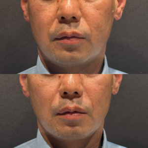 東京田町でヒアルロン酸リフトアップ｜40代男性がボリューマの効果・料金を解説の症例写真