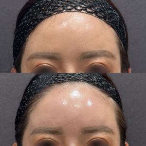 東京田町のヒアルロン酸｜30代女性が額・鼻にボリューマで自然なリフトアップを体験の症例写真