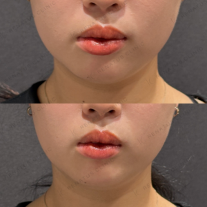 東京田町のヒアルロン酸顎形成｜20代女性がダイヤモンドフィール/ピネハで小顔への症例写真