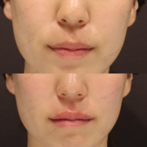 新宿で唇ヒアルロン酸が上手いクリニック｜ボルベラで叶えた30代女性の自然な厚みと形の症例写真