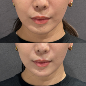 東京田町で顎ヒアルロン酸におすすめのボラックス｜20代女性の費用と効果の症例写真