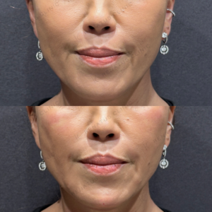 東京田町でヒアルロン酸ボライト｜50代女性のゴルゴライン・ほうれい線の効果と料金の症例写真