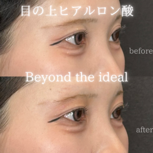 大阪梅田のヒアルロン酸｜目の上にボルベラを使った20代女性の効果と料金の症例写真