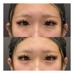 福岡天神で涙袋ヒアルロン酸｜10代女性がボルベラで自然な涙袋を形成した効果と料金の症例写真