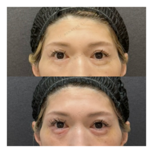 福岡天神で涙袋ヒアルロン酸｜50代女性のボリフト（VOLIFT）効果と料金相場の症例写真