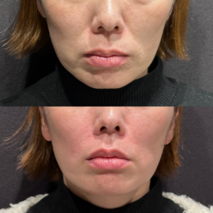 ほうれい線ヒアルロン酸ボリフト症例写真の症例写真