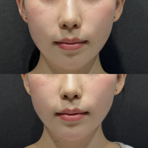 顎ヒアルロン酸ボラックス症例写真の症例写真