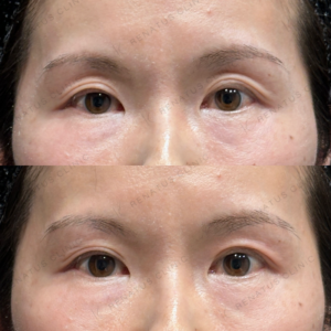 目の上ヒアルロン酸ボルベラ症例写真の症例写真