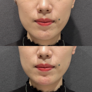 顎ヒアルロン酸ボラックス症例写真の症例写真