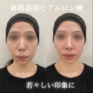 仙台で鼻翼基部ヒアルロン酸が上手いクリニックとは？20代女性の小鼻縮小効果と費用の症例写真