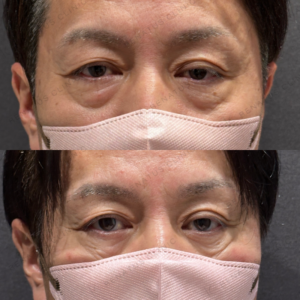 目の下のクマとり症例写真の症例写真