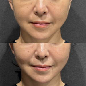 リフトアップヒアルロン酸ボリューマ症例写真の症例写真