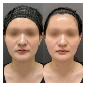 頬ヒアルロン酸ボリフト症例写真の症例写真