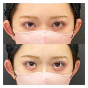 涙袋ヒアルロン酸ボルベラ症例写真の症例写真