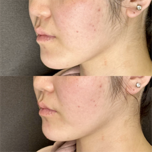 大阪梅田のヒアルロン酸で顎を整えるなら｜費用・効果・おすすめ製剤（ダイヤモンドフィール/ピネハ）20代女性の症例写真