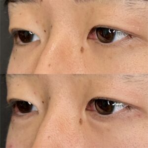 大阪梅田の涙袋ヒアルロン酸｜ボルベラで20代男性が自然な立体感を実現した効果と料金の症例写真