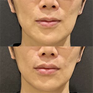 大阪梅田のヒアルロン酸｜40代男性のほうれい線・鼻翼基部にボリューマの効果と料金相場の症例写真