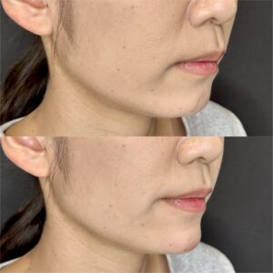大阪梅田のヒアルロン酸顎形成|ボラックスで叶える20代女性の小顔効果と料金相場の症例写真
