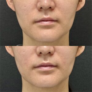 福岡天神でほうれい線ヒアルロン酸（ダイヤモンドフィール/ピネハ）の効果と料金｜30代女性の症例写真