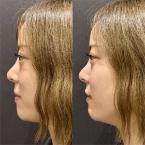 大阪梅田のヒアルロン酸でゴルゴライン・ほうれい線を改善｜ボリフト使用・30代女性の効果と料金の症例写真