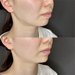 大阪梅田のヒアルロン酸顎形成｜ボラックスで叶えた20代女性の小顔・フェイスライン整形の費用と効果の症例写真