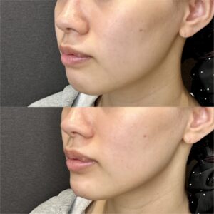 大阪梅田のヒアルロン酸顎形成｜20代女性がボラックスで理想のEラインへの症例写真