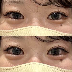 大阪梅田の涙袋ヒアルロン酸｜20代女性がボルベラで自然な涙袋を叶えた効果と料金の症例写真