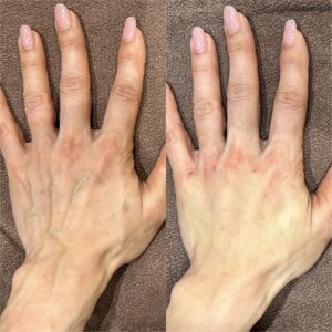 大阪梅田で手の甲ヒアルロン酸｜ボリフトの効果・料金相場【40代女性】の症例写真