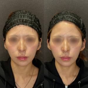 名古屋で立ち耳にヒアルロン酸ボリフト｜20代女性の効果と料金の症例写真