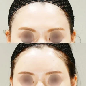 東京田町の額ヒアルロン酸が上手い｜ボリューマ（VOLUMA）で20代女性の丸く自然なおでこへの症例写真