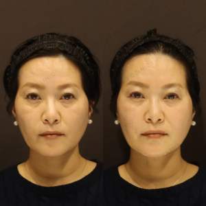 【ほうれい線ヒアルロン酸】骨格から支えて深さ軽減｜50代女性 【代々木】の症例写真