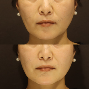 【ほうれい線ヒアルロン酸】骨格から支えて深さ軽減｜50代女性 【代々木】の症例写真