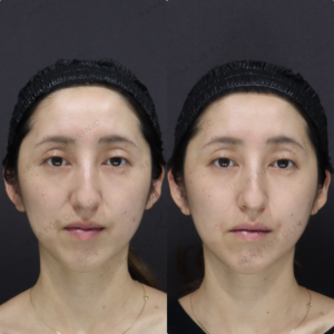 【ほうれい線ヒアルロン酸】中顔面サポートで自然な改善｜ダイヤモンドフィール 30代女性 【新宿】の症例写真