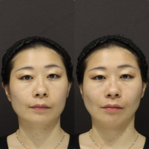 【ほうれい線ヒアルロン酸】中顔面サポートで自然な改善｜30代女性 【新宿】の症例写真